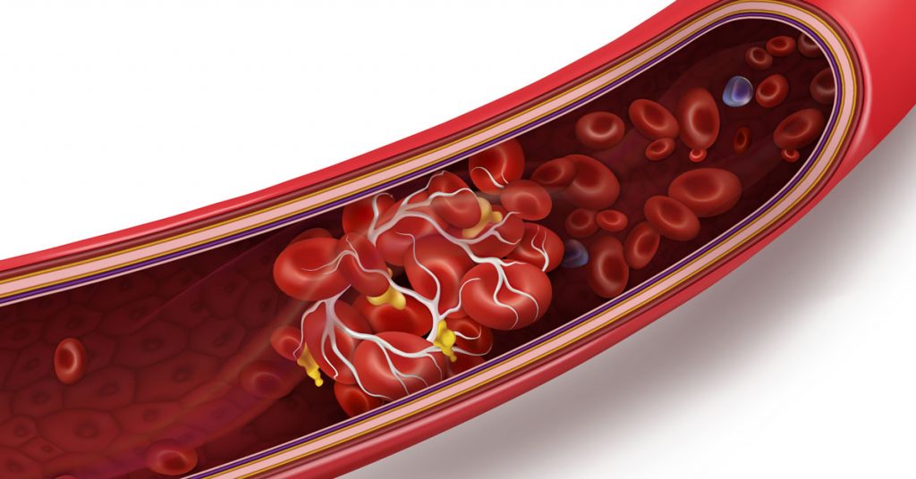 Cục máu đông di chuyển trong lòng mạch gây tắc nghẽn dòng máu và gây ra đột quỵ